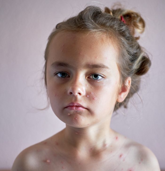 Portrait of a lovely 6 years old little girl with chickenpox